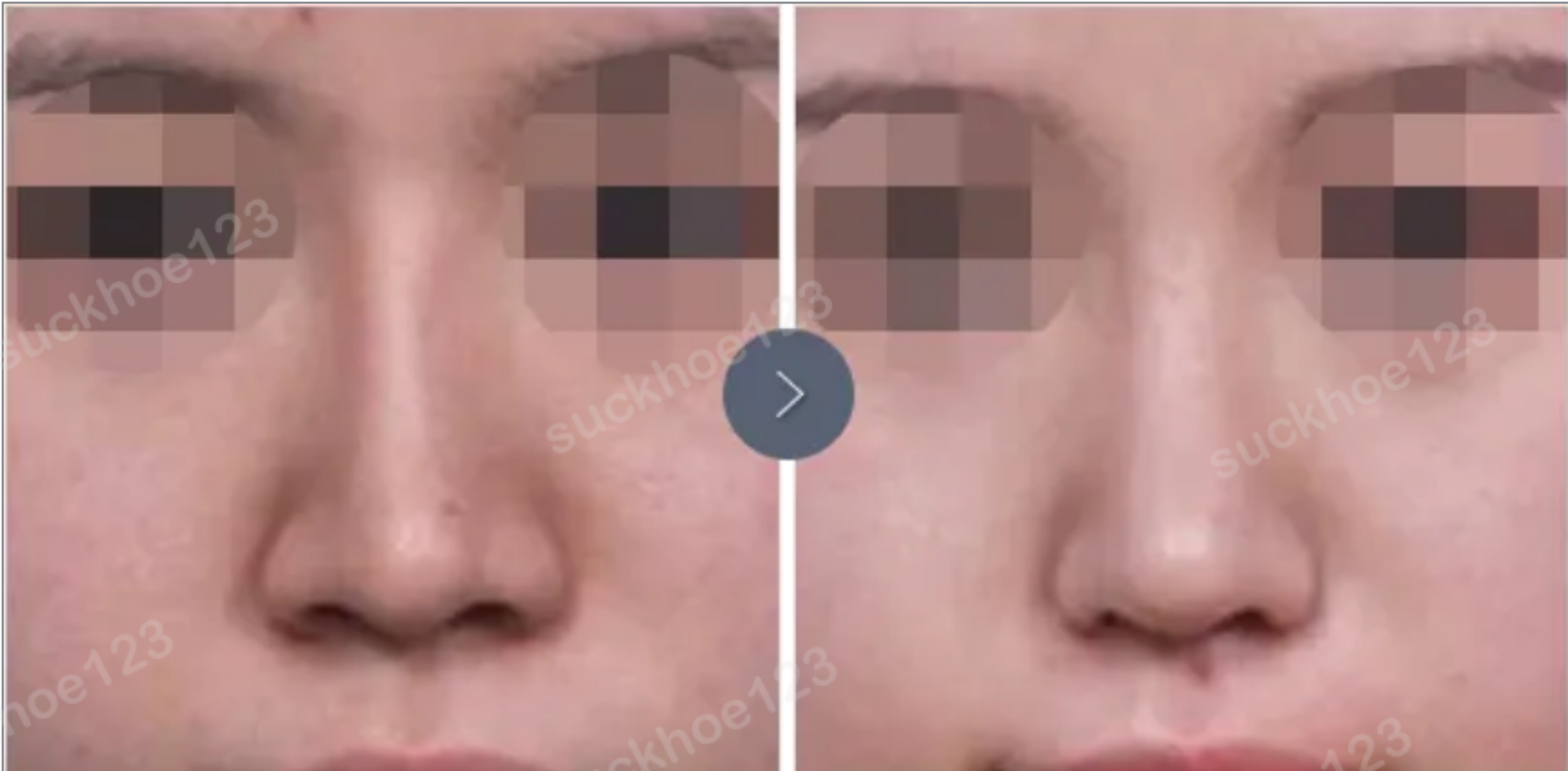 mũi lộ sống trước sau chỉnh sửa 3