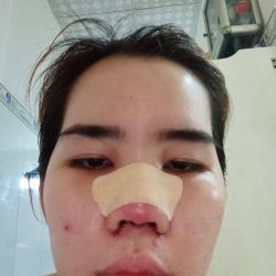 Nâng mũi 3 ngày mà đầu mũi đỏ vậy có sao không?