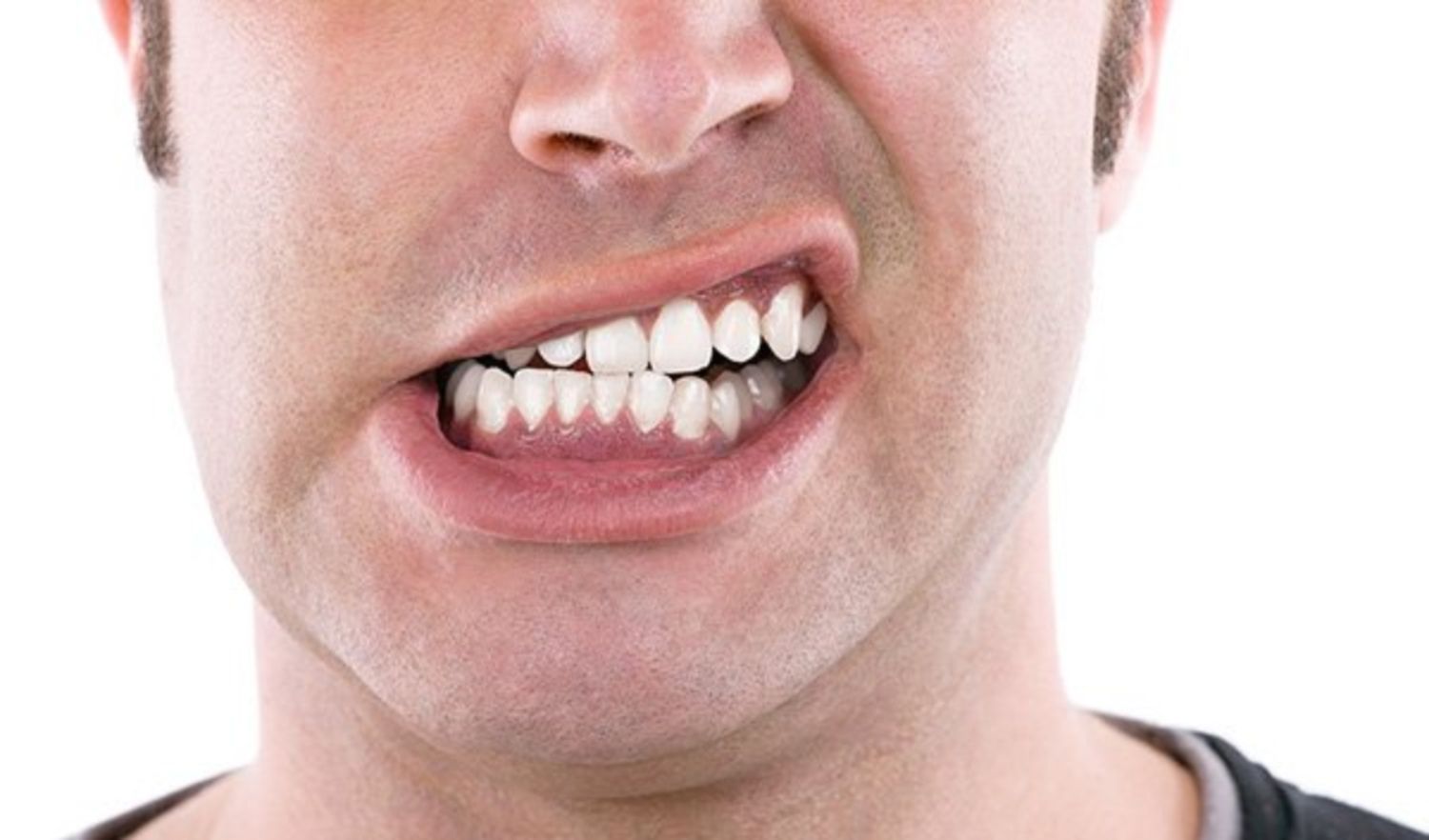 nghiến răng gây đau hàm