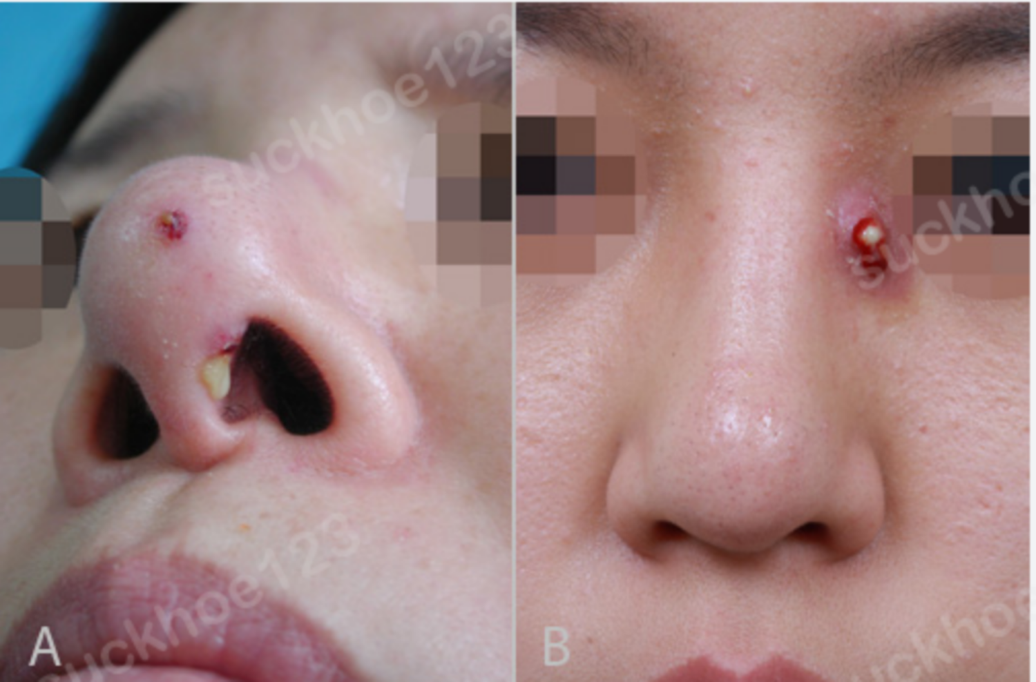 Nhiễm trùng sau nâng mũi: nguyên nhân và cách xử lý