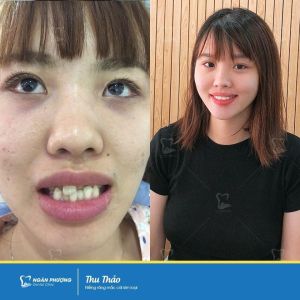 Hình ảnh niềng răng thành công của KH Thu Thảo – Ca 10