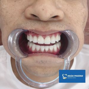 Hình ảnh bọc răng sứ của một nam KH – Ca 11