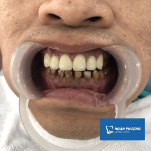 Hình ảnh bọc răng sứ của một nam KH – Ca 11