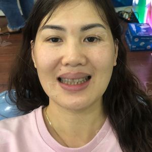 Hình ảnh bọc răng sứ của một chị KH có răng bị nhiễm Tetracycline – Ca 12