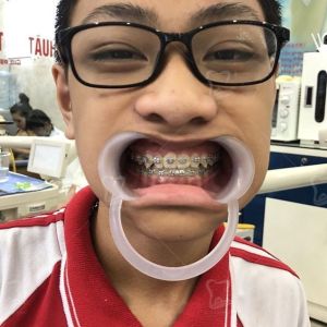 Hình ảnh niềng răng của KH Hoàng Tùng Lâm – Ca 13