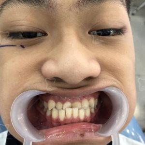 Hình ảnh niềng răng của KH Hoàng Tùng Lâm – Ca 13