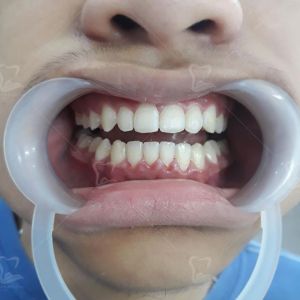 Hình ảnh niềng răng của KH Hoàng Tùng Lâm – Ca 13