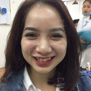 Hình ảnh bọc răng sứ của một nữ KH xinh đẹp – Ca 14