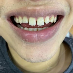 Hình ảnh bọc răng sứ của một bạn nam trẻ tuổi – Ca 15