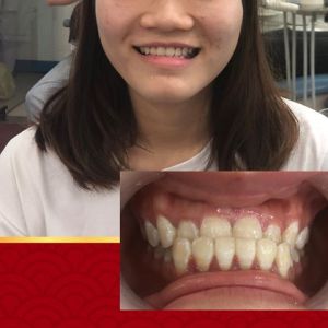 Hình ảnh niềng răng thành công của KH Đặng Thị Huyền – Ca 17