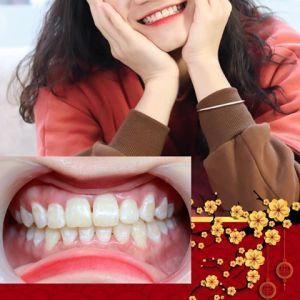 Hình ảnh niềng răng thành công của KH Đặng Thị Huyền – Ca 17