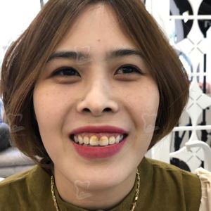 Hình ảnh điều trị cười hở lợi của 1 chị KH – Ca 18