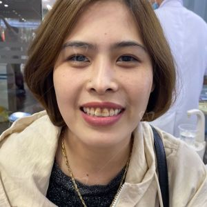 Hình ảnh điều trị cười hở lợi của 1 chị KH – Ca 18