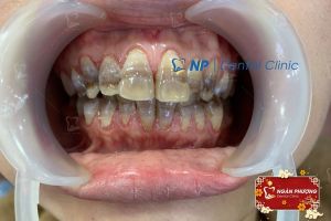 Hình ảnh bọc răng sứ của 1 chị KH có răng bị nhiễm kháng sinh trầm trọng – Ca 19