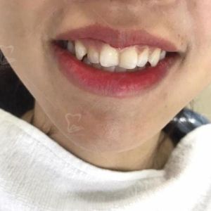 Hình ảnh bọc răng sứ của một KH nữ trẻ trung xinh đẹp – Ca 1