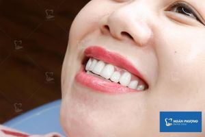 Hình ảnh bọc răng sứ của KH chị Hoa – Ca 21