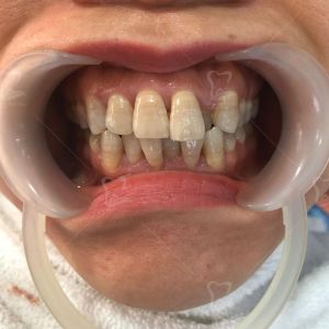 Hình ảnh bọc răng sứ của KH chị Hoa – Ca 21