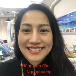 Hình ảnh bọc răng sứ và cắt lợi của 1 KH nữ đẹp quý phái – Ca 22