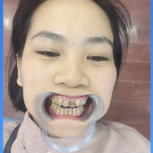 Hình ảnh bọc răng sứ của 1 nữ KH – Ca 23