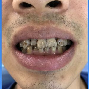 Hình ảnh bọc răng sứ của một KH nam – Ca 24