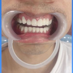 Hình ảnh bọc răng sứ của một KH nam – Ca 24