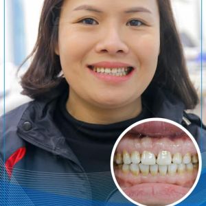Hình ảnh bọc răng sứ của KH nữ đến từ Nghệ An – Ca 25
