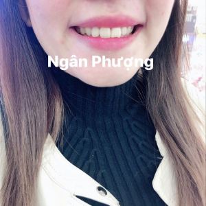 Hình ảnh niềng răng của KH Hường Nguyễn – Ca 26