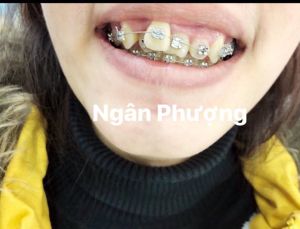 Hình ảnh niềng răng của KH Hường Nguyễn – Ca 26