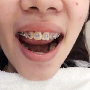 Hình ảnh niềng răng của KH Hường Nguyễn – Ca 26
