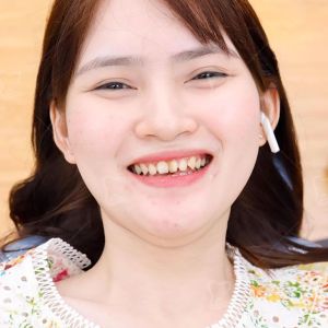 Hình ảnh bọc răng sứ của KH Bích Vy – Ca 2