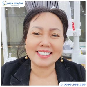 Hình ảnh bọc răng sứ của một nữ KH trung tuổi – Ca 3