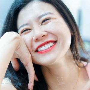 Hình ảnh bọc răng sứ của một bạn gái có hàm răng hô nhẹ - Ca 5