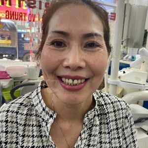 Hình ảnh bọc răng sứ của 1 nữ KH có gương mặt rạng rỡ - Ca 6