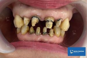 Hình ảnh bọc răng sứ của 1 nữ KH có gương mặt rạng rỡ - Ca 6