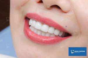 Hình ảnh bọc răng sứ của 1 nữ KH có gương mặt rạng rỡ - Ca 6