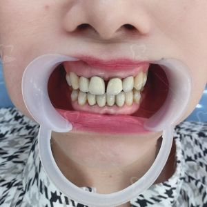Hình ảnh bọc răng sứ của 1 nữ KH có gương mặt rạng rỡ - Ca 6