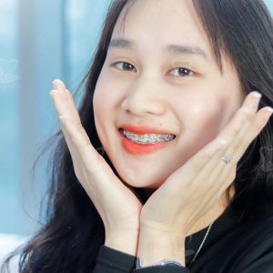 Hình ảnh niềng răng của bạn Nhung – Ca 7