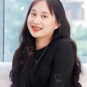 Hình ảnh niềng răng của bạn Nhung – Ca 7