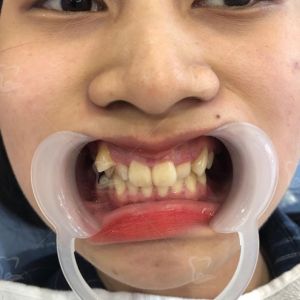 Hình ảnh niềng răng của bạn Nhung – Ca 7
