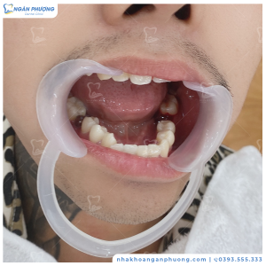 Hình ảnh niềng răng của KH Đạt G – Ca 8
