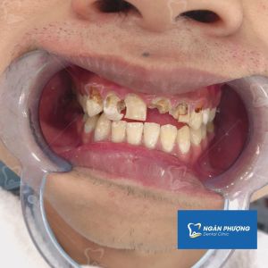 Hình ảnh bọc răng sứ cho 1 nam thanh niên bị sâu răng trầm trọng – Ca 9