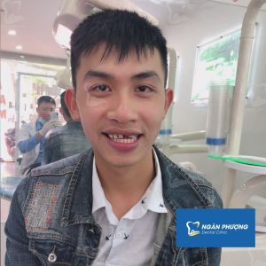 Hình ảnh bọc răng sứ cho 1 nam thanh niên bị sâu răng trầm trọng – Ca 9