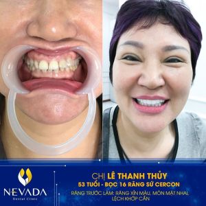 Hình ảnh bọc 16 răng sứ Cercon của KH Lê Thanh Thủy – Ca 100