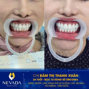 Hình ảnh bọc 16 răng sứ Zirconia của KH Đàm Thị Thanh Xuân – Ca 101