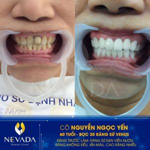 Hình ảnh bọc 20 răng sứ Venus của KH Nguyễn Ngọc Yến – Ca 102