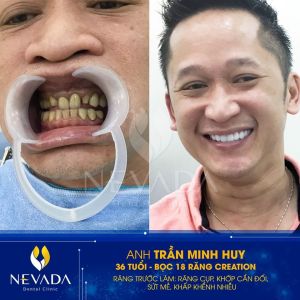 Hình ảnh bọc 18 răng Creation của KH Trần Minh Huy – Ca 103