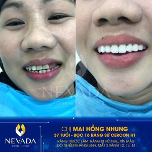 Hình ảnh bọc 16 răng sứ Cercon HT của KH Mai Hồng Nhung - Ca 104