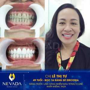 Hình ảnh bọc 16 răng sứ Zirconia của KH Lê Thị Tư – Ca 105
