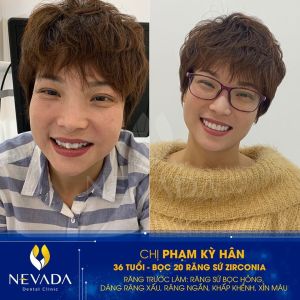 Hình ảnh bọc 20 răng sứ Zirconia của KH Phạm Kỳ Hân – Ca 106