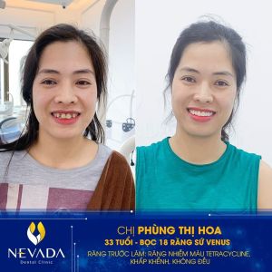Hình ảnh bọc 18 răng sứ Venus của KH Phùng Thị Hoa – Ca 107